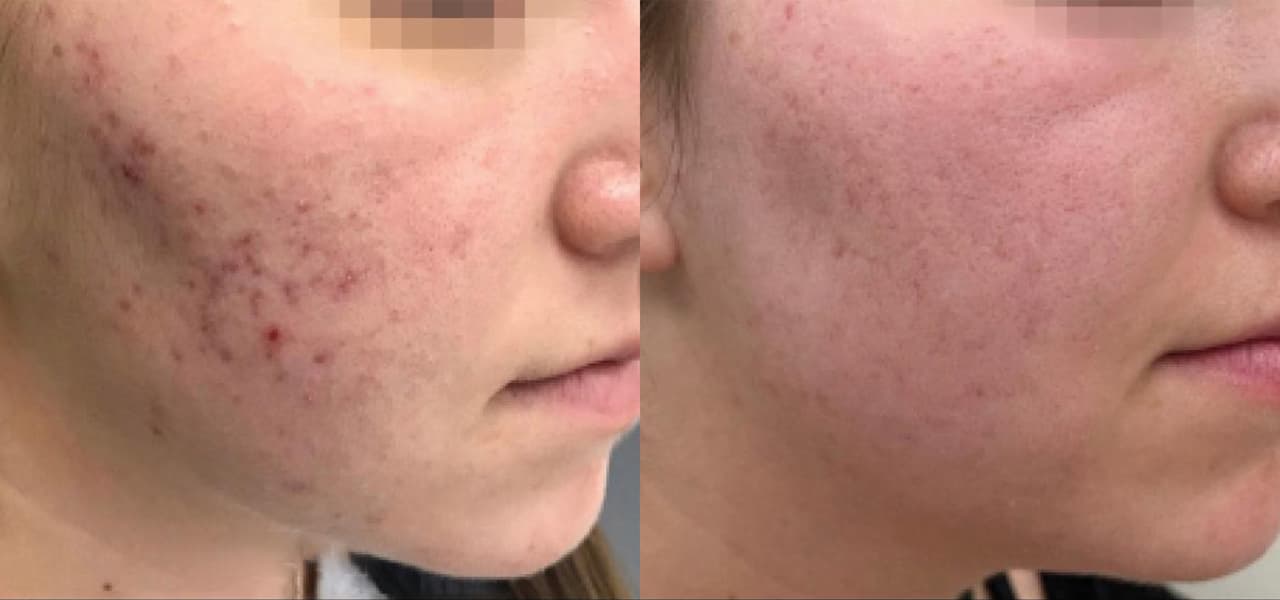 Laser Acne Treatment before and after 1