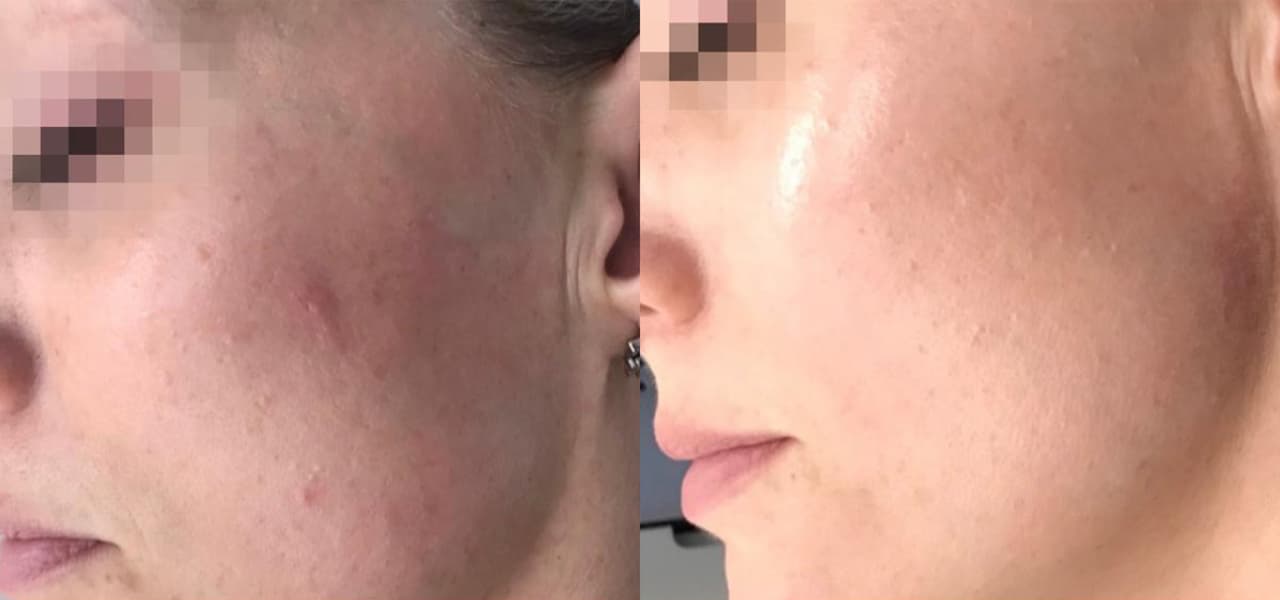 Laser Acne Treatment before and after 2