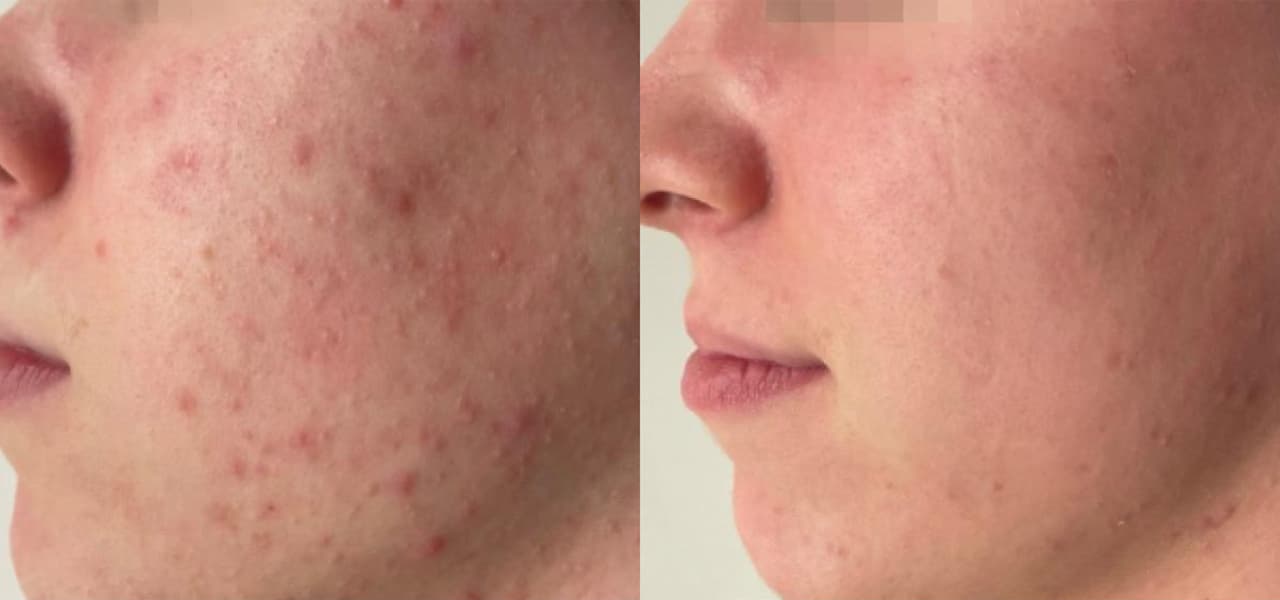Laser Acne Treatment before and after 3